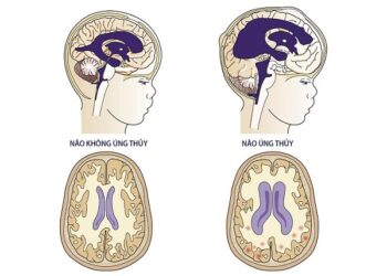 Não úng thuỷ là gì? Nguyên nhân gây não úng thuỷ?