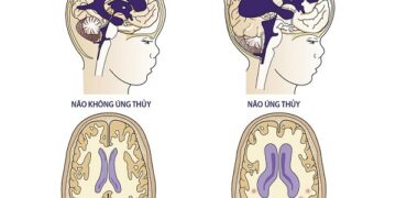 Não úng thuỷ là gì? Nguyên nhân gây não úng thuỷ?