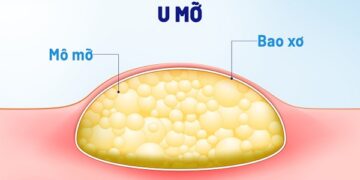 U mỡ : Nguyên nhân, triệu chứng, chẩn đoán và điều trị