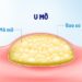 U mỡ : Nguyên nhân, triệu chứng, chẩn đoán và điều trị