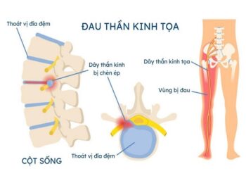 Đau thần kinh tọa là gì? Các yếu tố nguy cơ và biện pháp phòng ngừa